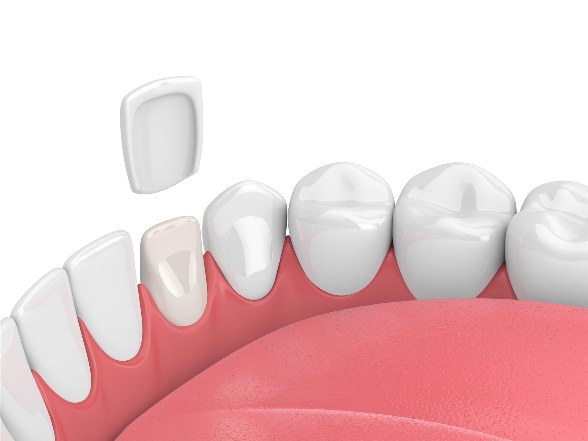 Get the Perfect Smile With Porcelain Veneers!