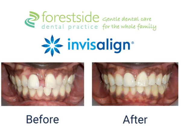 invisalign before and after