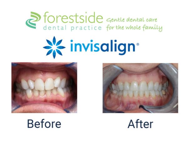 invisalign invisible braces