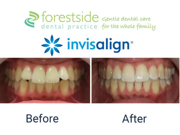 invisalign prices
