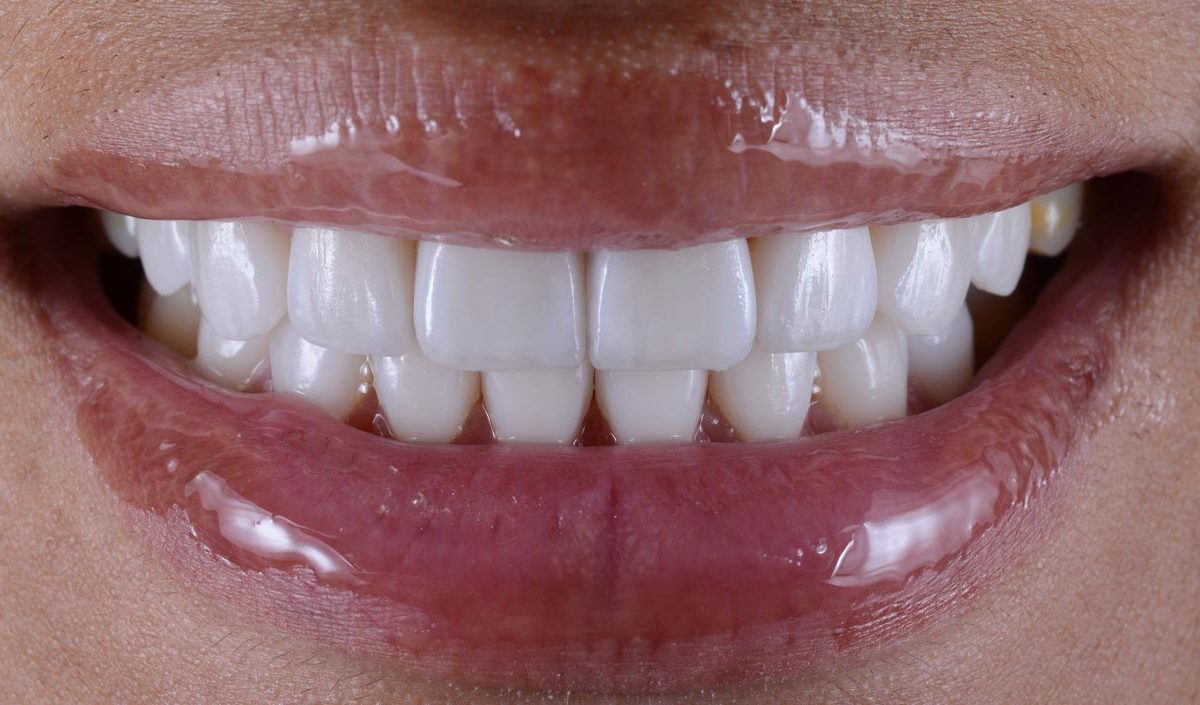 dental crowns before and after