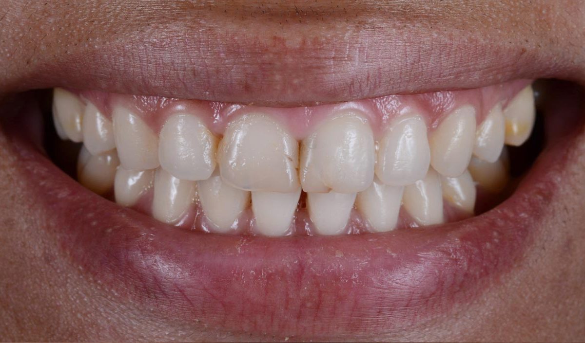 dental crowns before and after