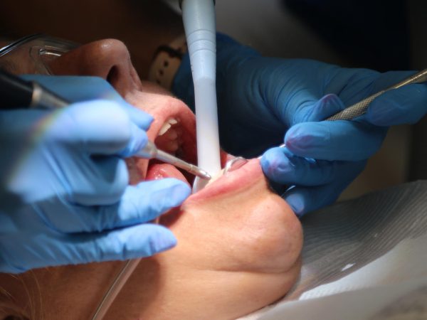 dental tooth crown procedure