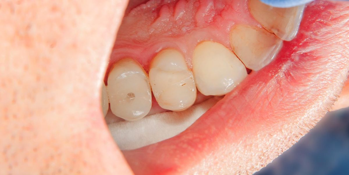 root canal treatment after