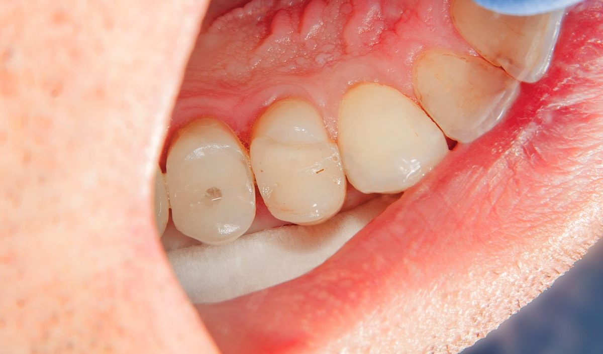 root canal treatment after