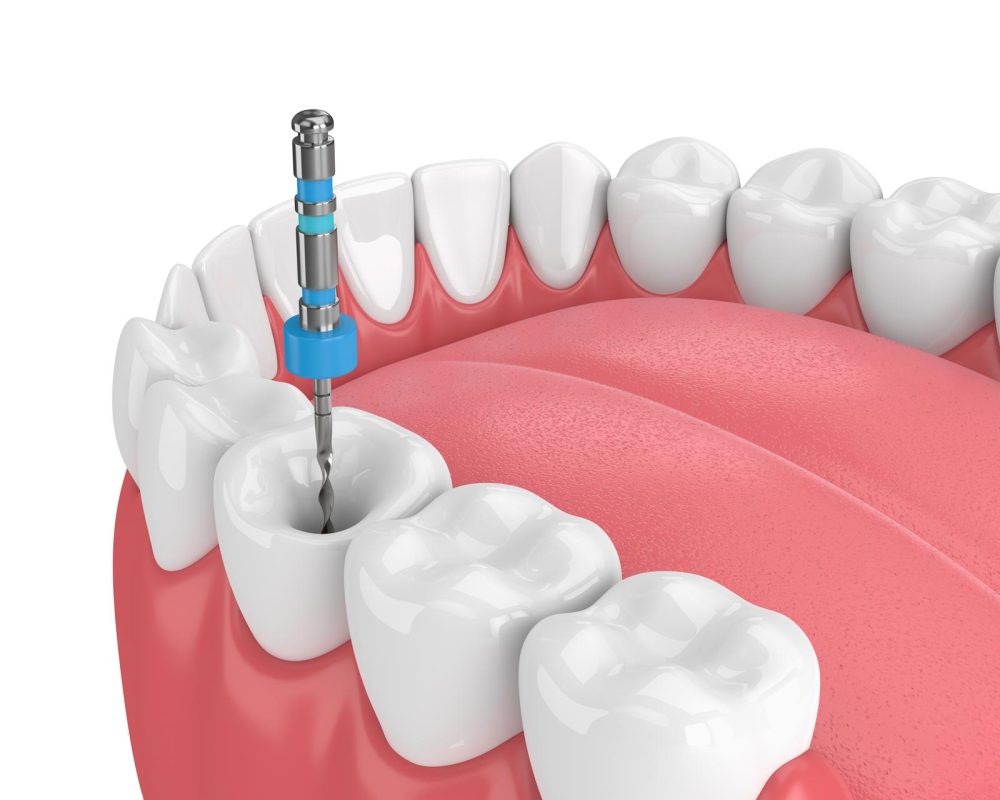 causes and root canal preventions