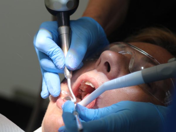 root canal