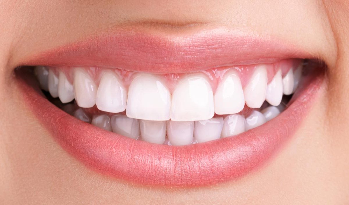 teeth whitening after