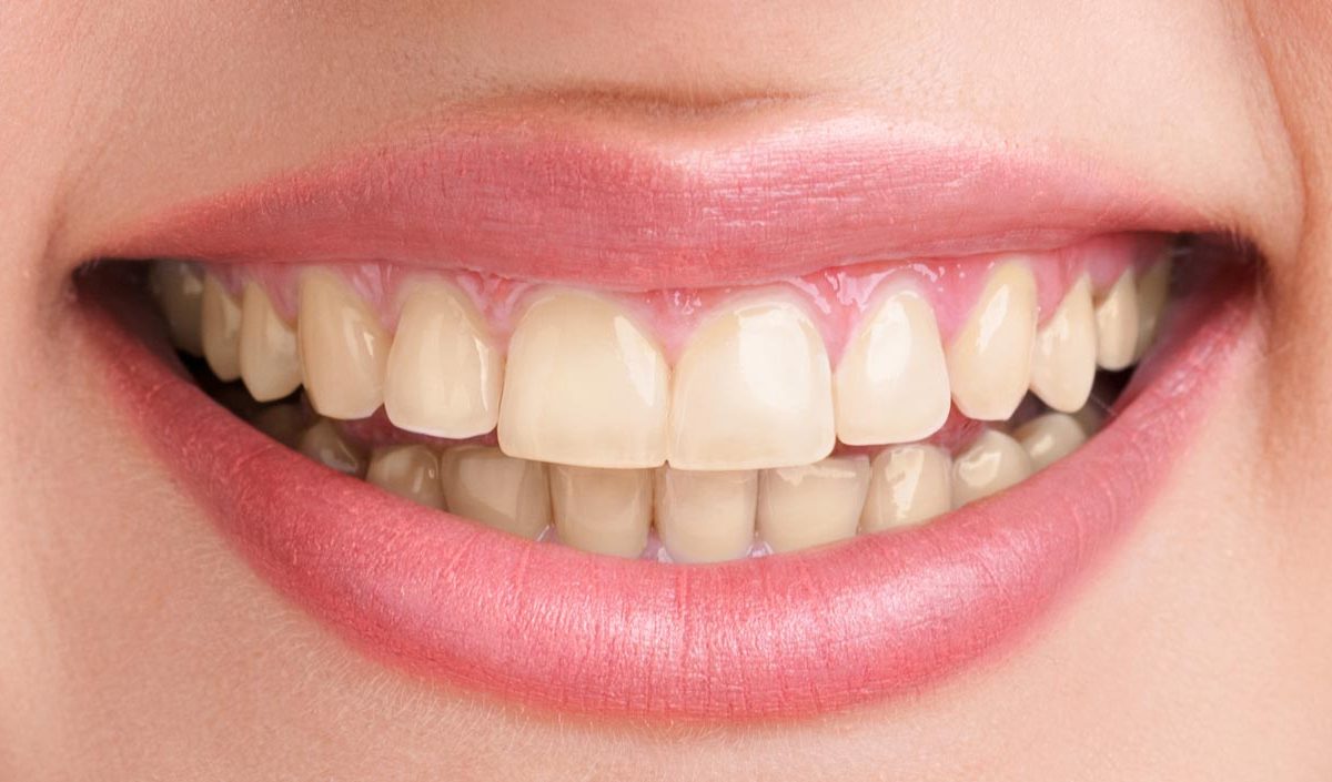 teeth whitening before