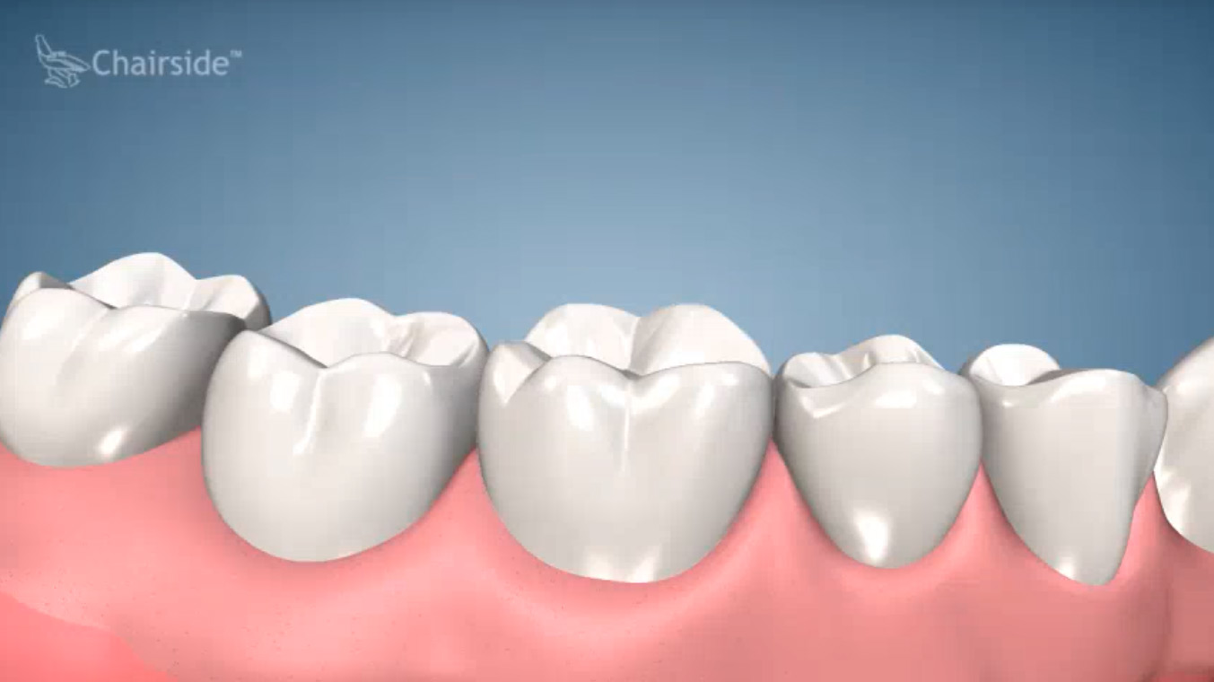 What Are the Benefits of Dental Implants?