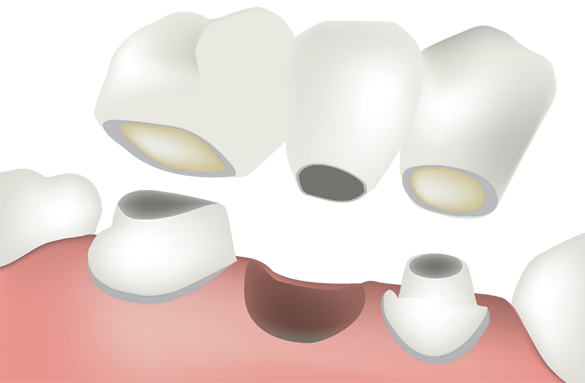 dental bridge cosmetic bassett