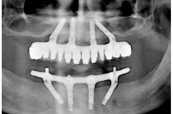 all-on-4-dental-implants