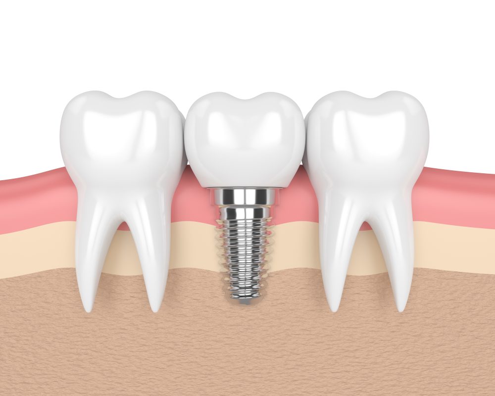 regain-smile-with-dental-implants