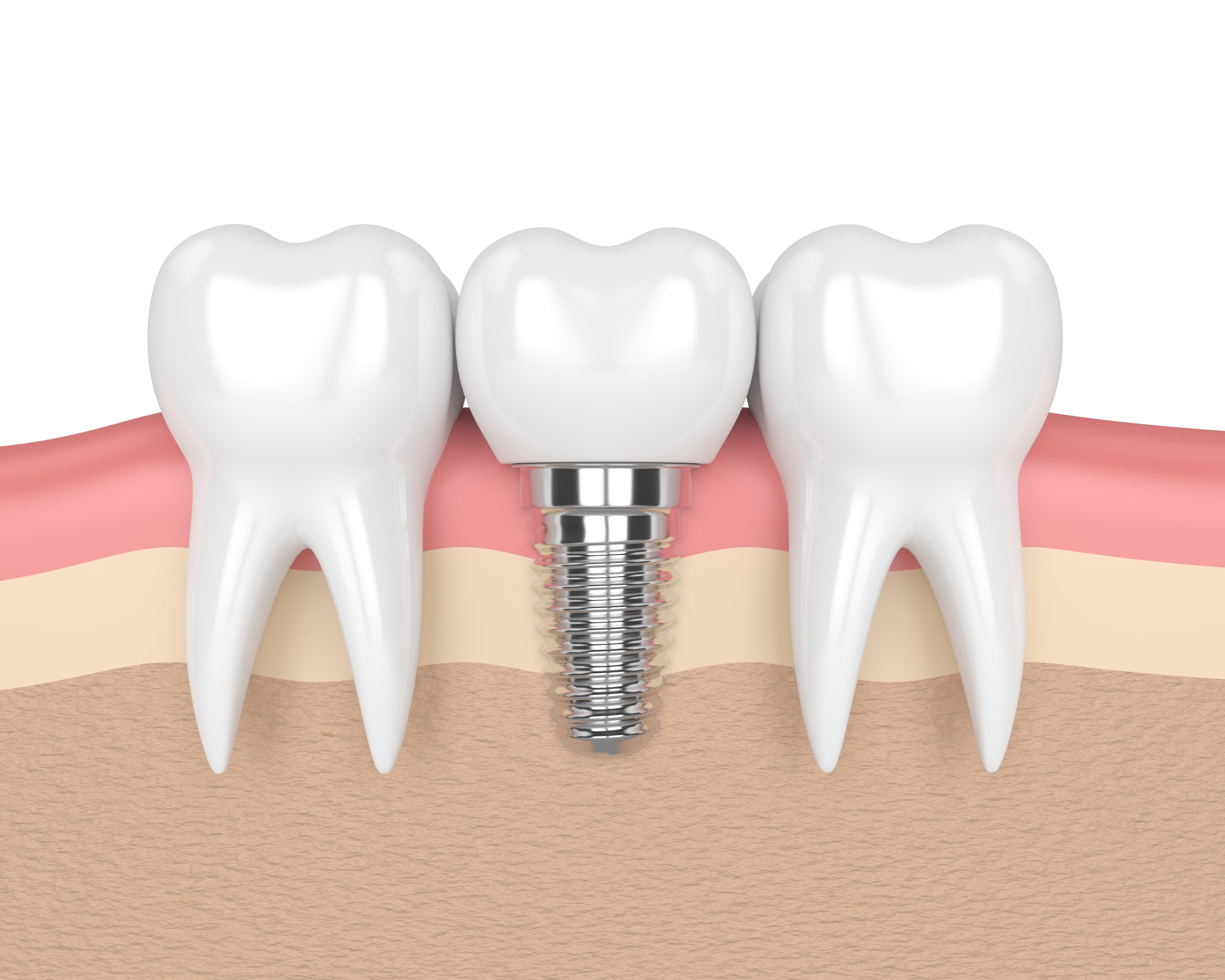 What are Same Day Implants?