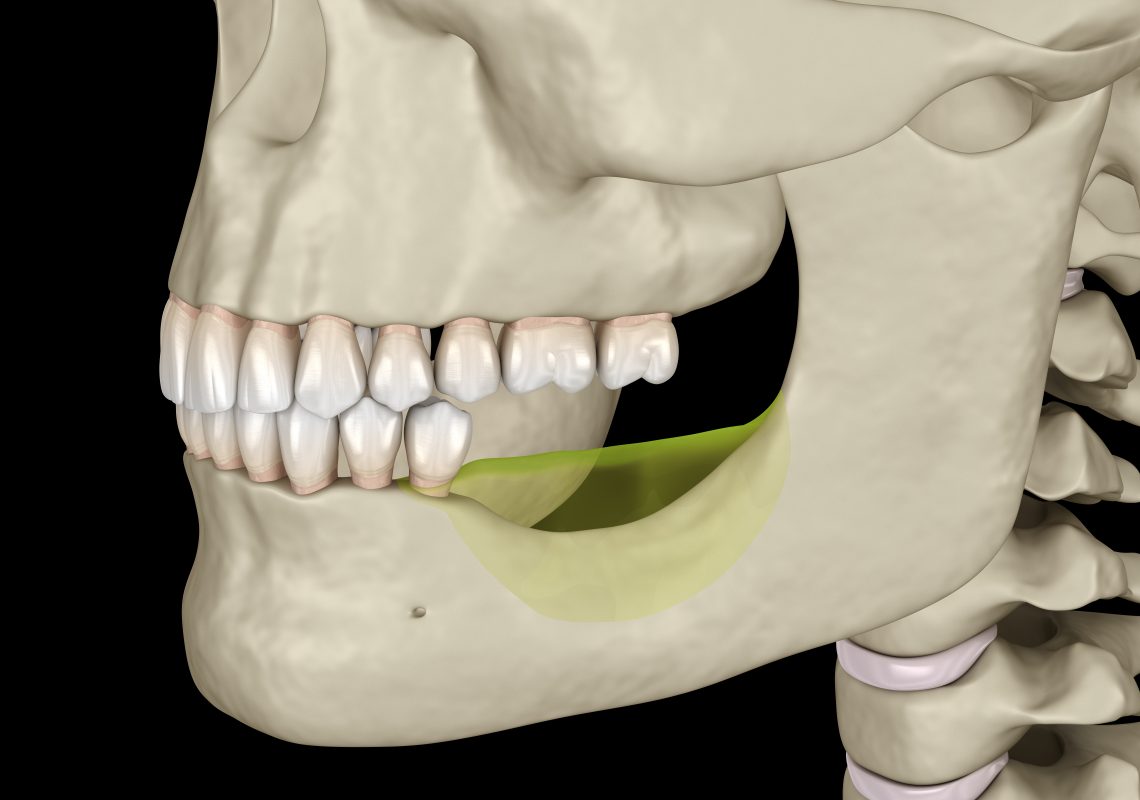 dental-implants-prevent-Jawbone-loss