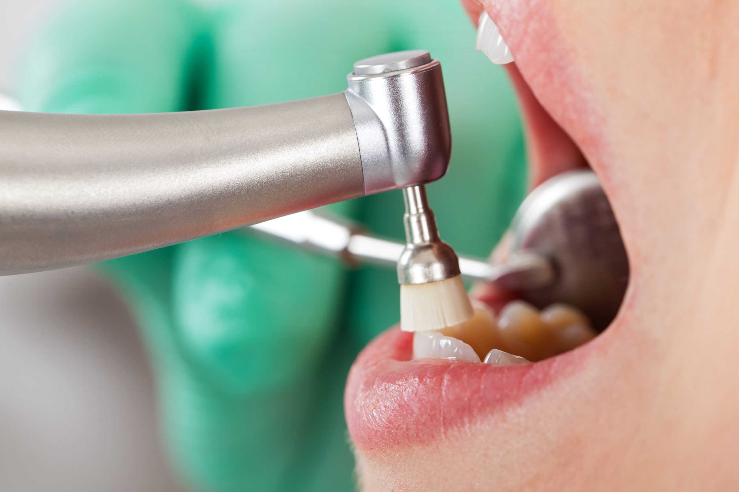 The Importance of Visiting a Hygienist