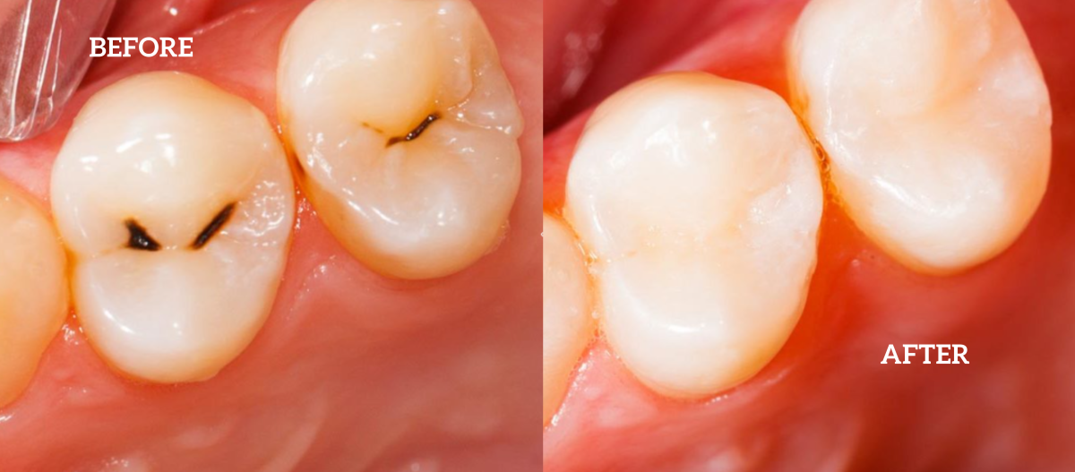 before and after dental fillings