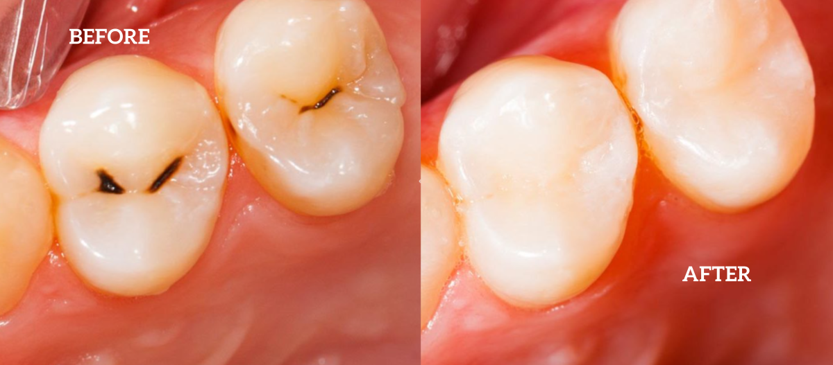 before and after dental fillings 