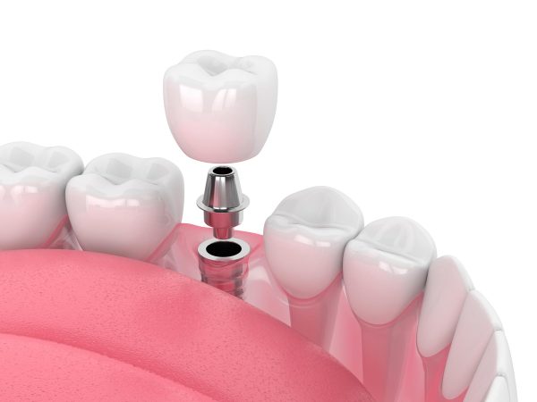 all on 4 dental implants cost highcliffe
