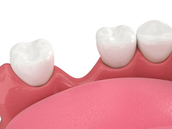 all on four dental implants highcliffe