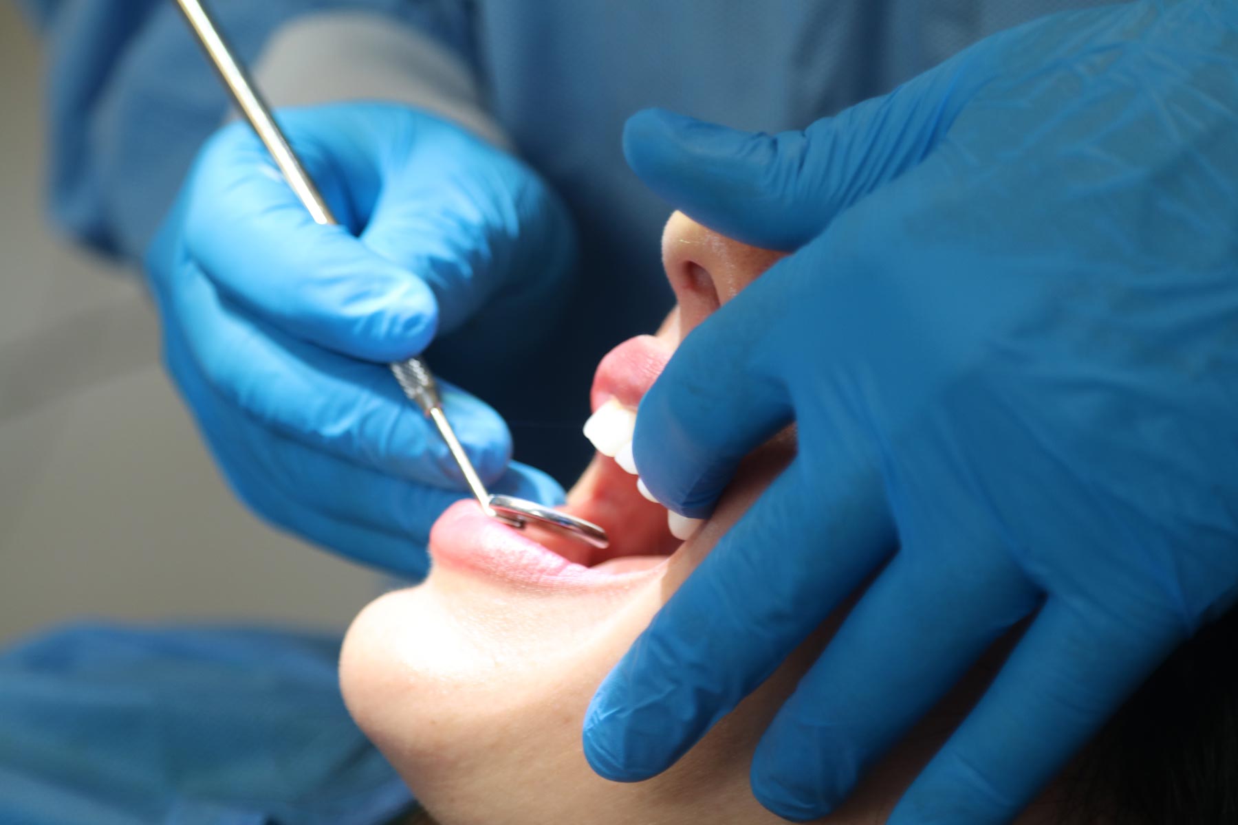 Silver vs White Fillings: Which One Should You Choose?