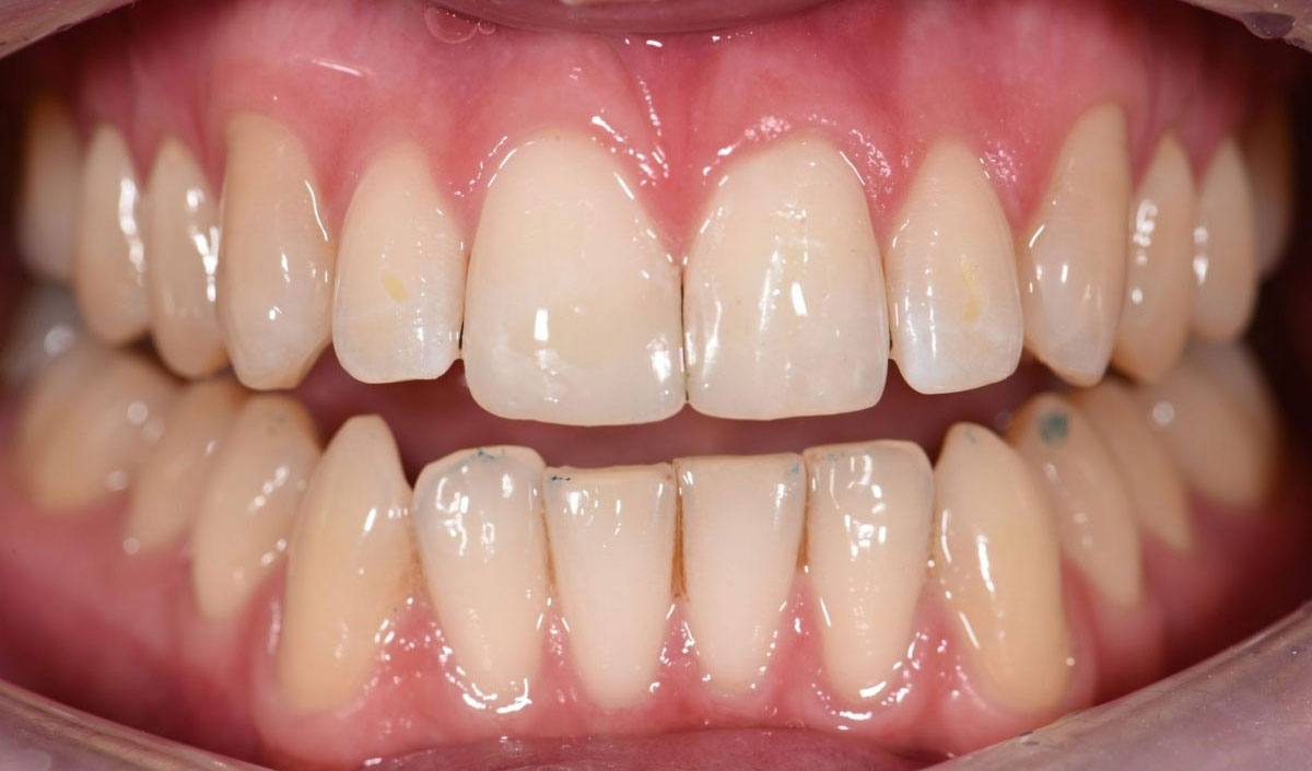 composite bonding after