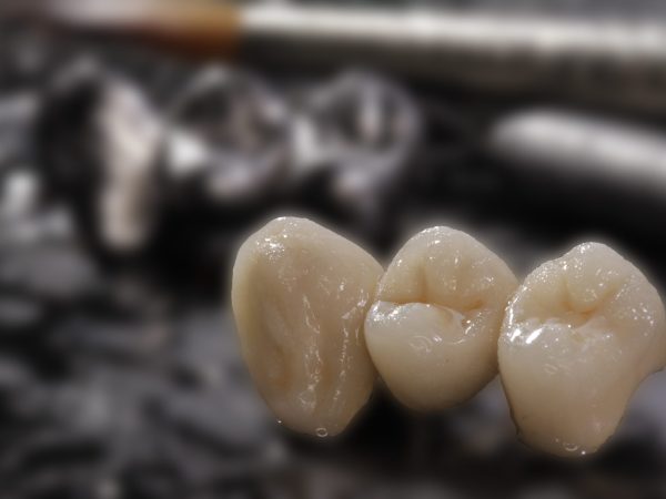 dental bridges marchwood