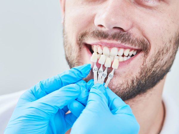 veneers marchwood