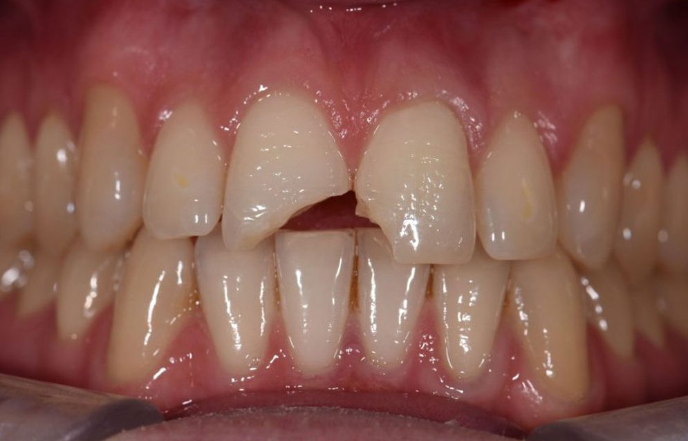 composite bonding before