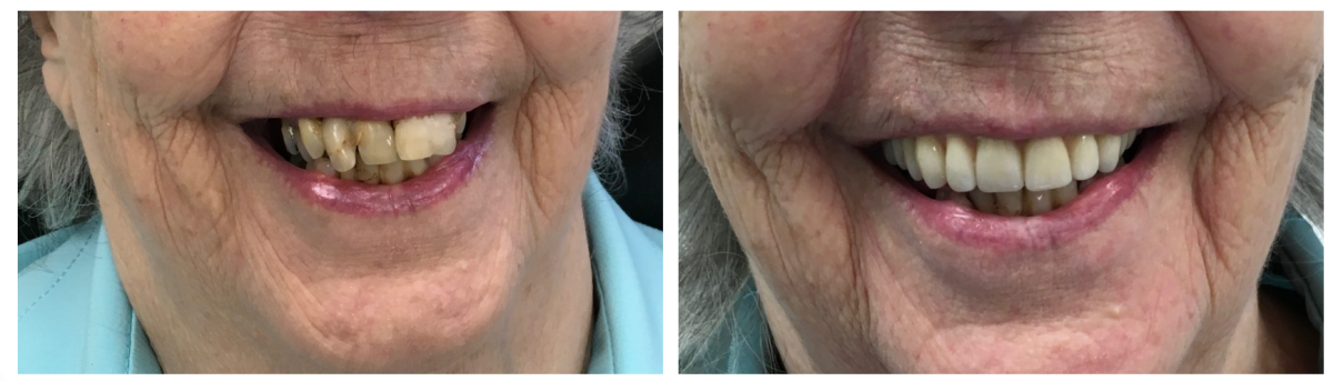 before and after dental bridge