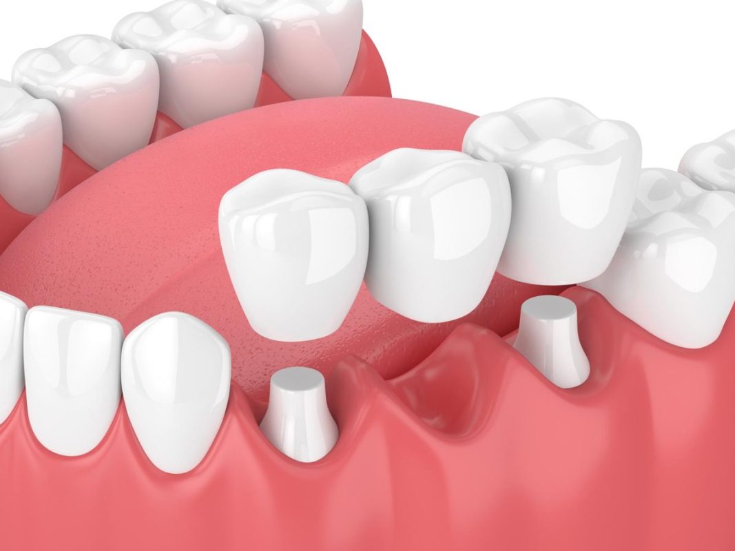 dental bridge types
