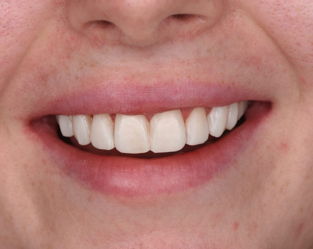 oral health after smoking