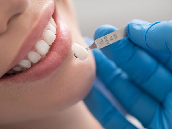 crown before and after dental bridge