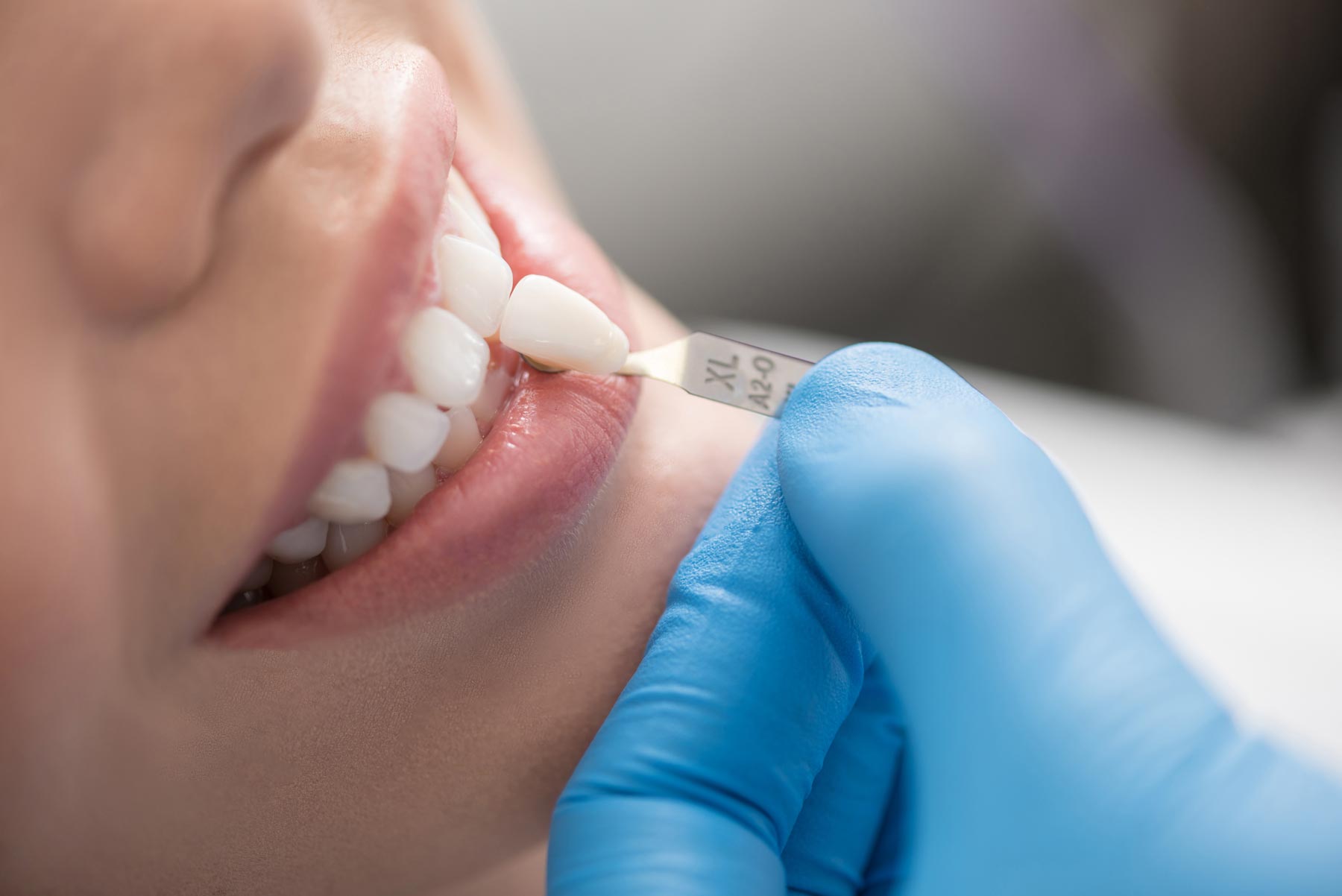 dental crown costs southampton