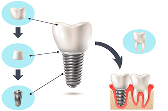 ICOI-dental-implants-fawley