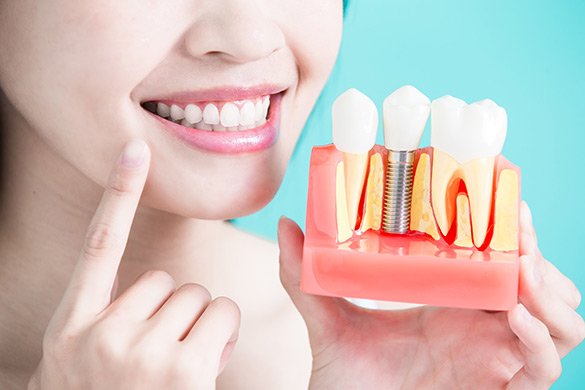 dental-implants-fawley