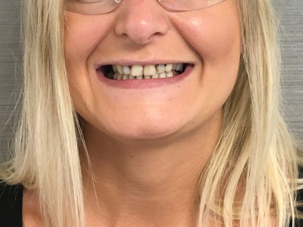 gaps in smile before veneers