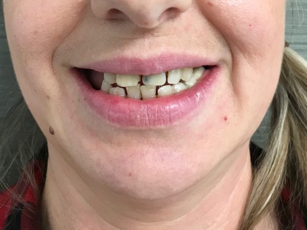 composite bonding teeth alignment before