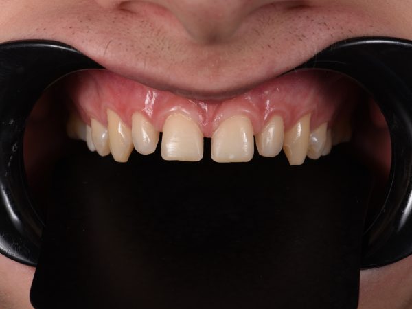 teeth with gaps before veneers