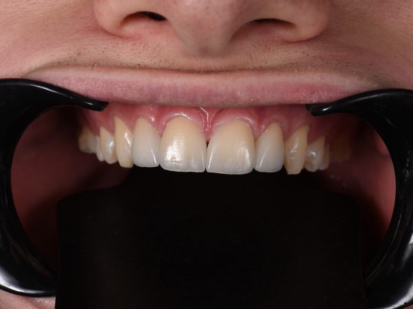 teeth with gaps after veneers
