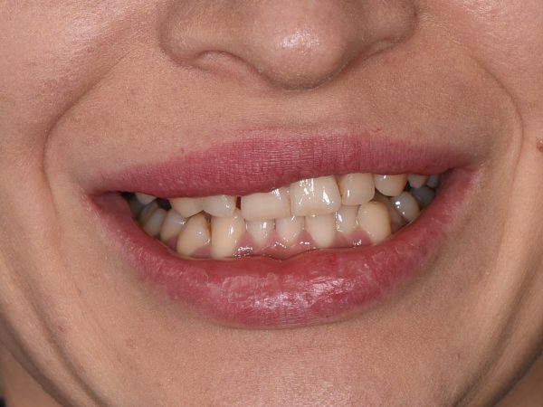 uneven smile before veneers