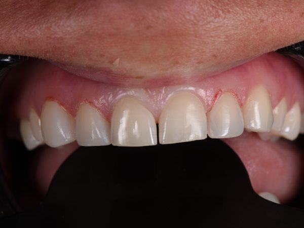 composite bonding after