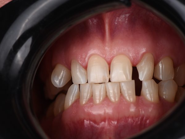 composite bonding close up before