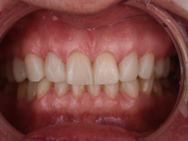 composite bonding close up after