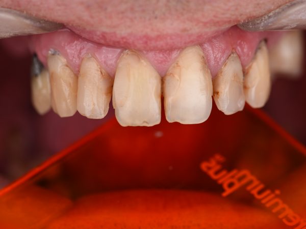 composite bonding decay before