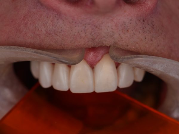 composite bonding decay after