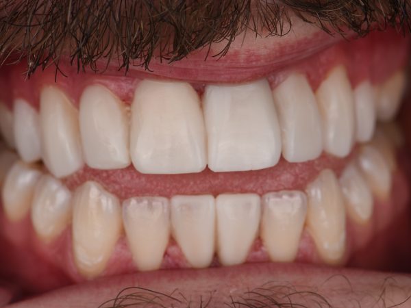 composite bonding teeth after