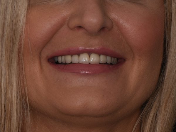 gaps in smile after veneers