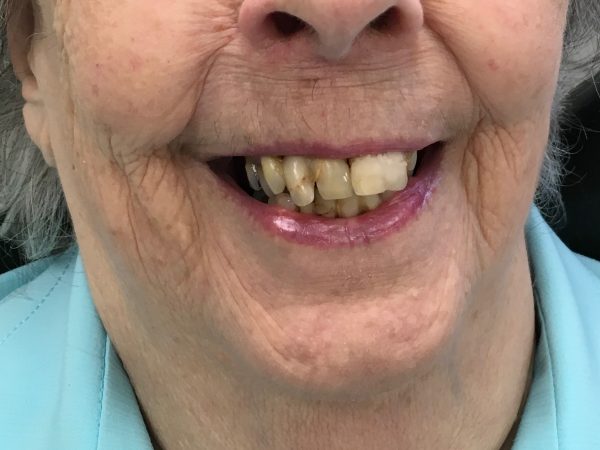 upper bridge implants before