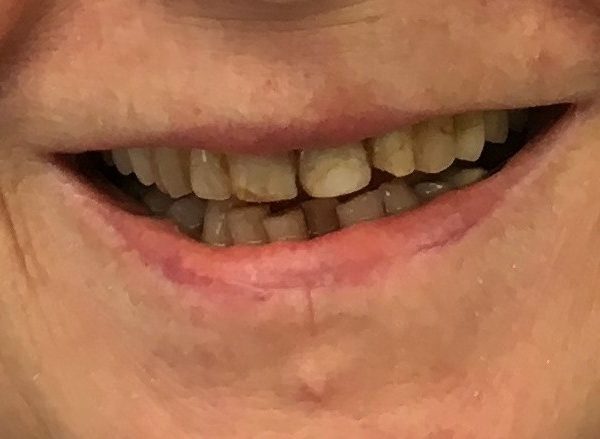 teeth stains before crowns